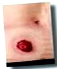 stomas gyulladásos