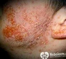 streptoderma