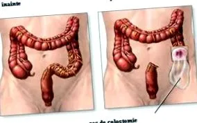 stomas stomas