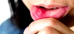 stomatitis