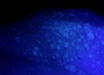 pityriasis
