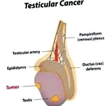 hererák varicocele