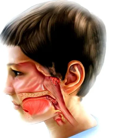 adenoid amit