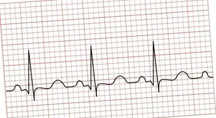 tachycardia