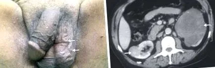 varicocele varicocele