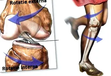 bursitis