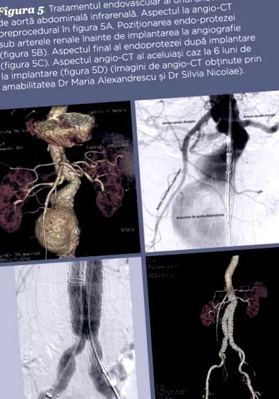 aorta