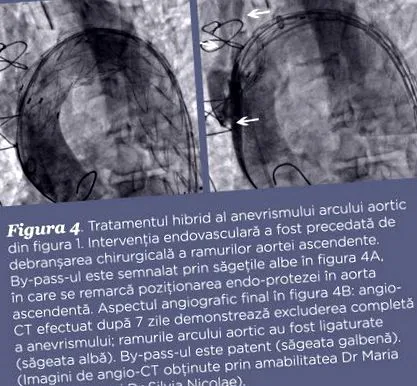aneurysma