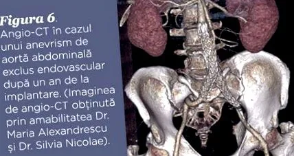 aneurysma