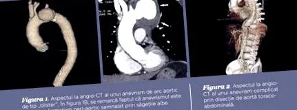 aorta