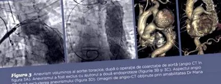 aorta