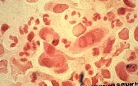 ureaplasma