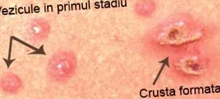bárányhimlő