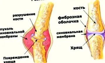 ureaplasmosis