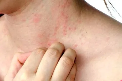 egészségről urticaria