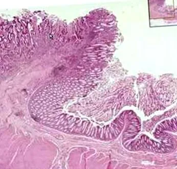 adenokarcinóma