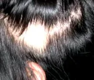 alopecia