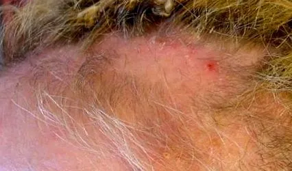 alopecia
