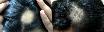 alopecia areata