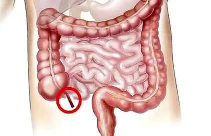 апендицитис третман