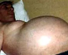 ascites hasat