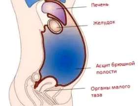 kezelését ascites