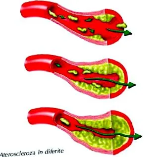 arteriopathia megsemmisítése