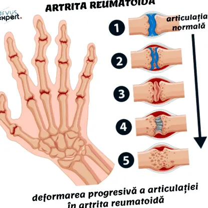 interphalangealis