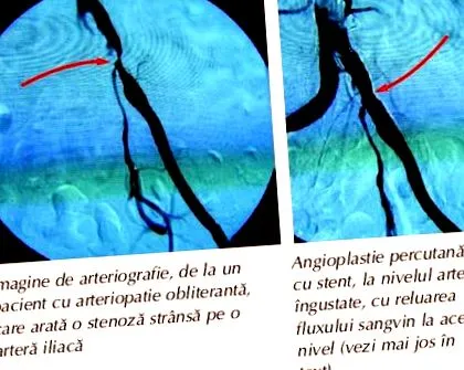 arteriopathia arteriopathia