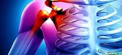 osteoarthritis