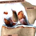 gonartrózis