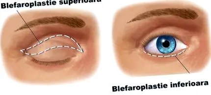 ajánlott blepharoplasztika