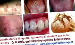 giardia