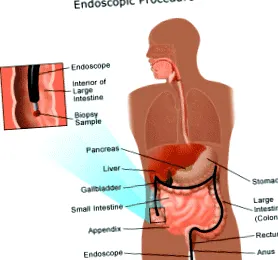 Crohn-kór fekélyes