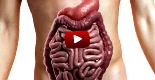 crohn-betegség
