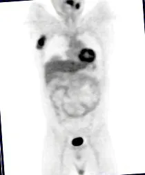 neuroendokrin