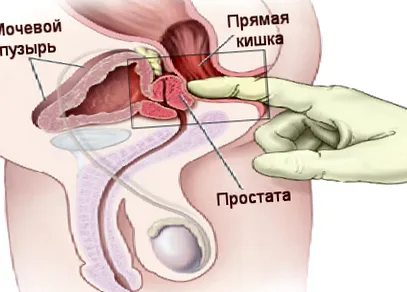 калцификација причини