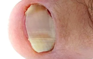 candida