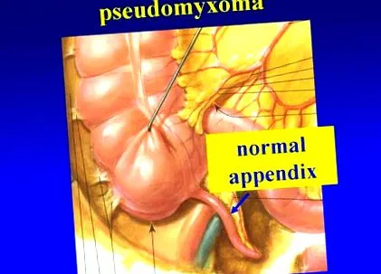 pseudomyxoma