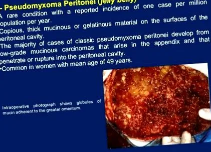 pseudomyxoma