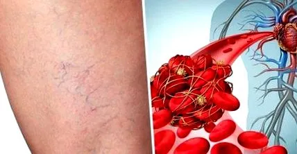 phlebitis