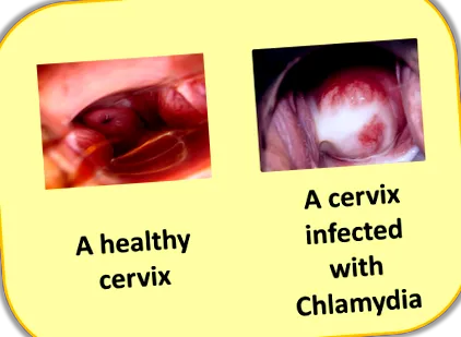 chlamydia