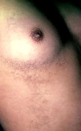 gyógymód papillomatosis