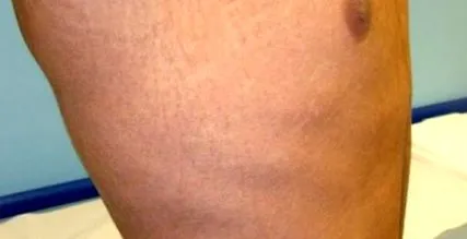 reticulated