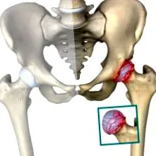 coxarthrosis coxarthrosis