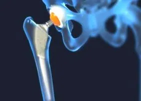 coxarthrosis