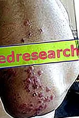 dermatitis