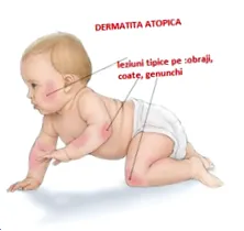 алергиски ринитис алергиски дерматози