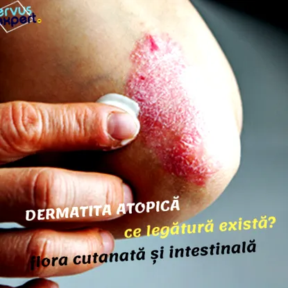 atópiás dermatitis