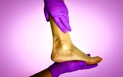 stasis dermatitis